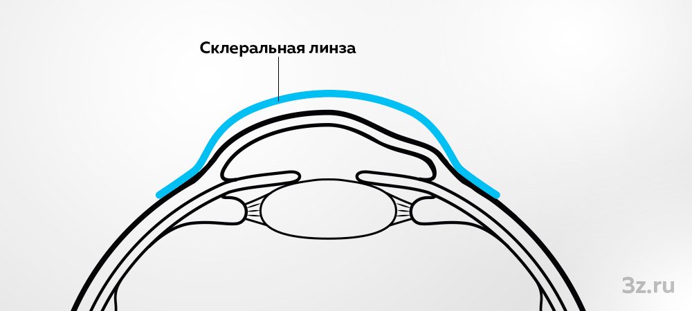 Новая услуга: склеральные линзы для коррекции зрения при кератоконусе 