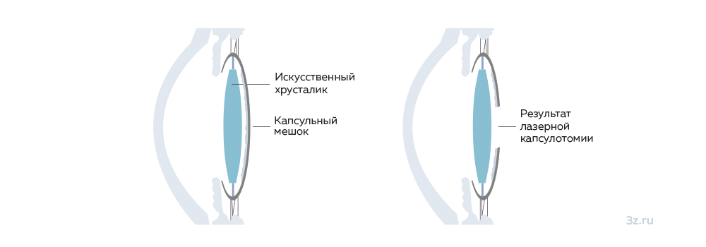 Удаление вторичной катаракты с помощью лазерной капсулотомии