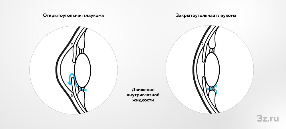 Закрытоугольная глаукома. Первичная открытоугольная глаукома клиника. Открытоугольная и закрытоугольная глаукома. Открытоугольная и закрытоугольная глаукома разница. Открытоугольная глаукома 4с артифакия.