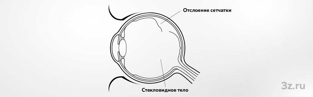 Клиника федорова краснодар отслоение сетчатки