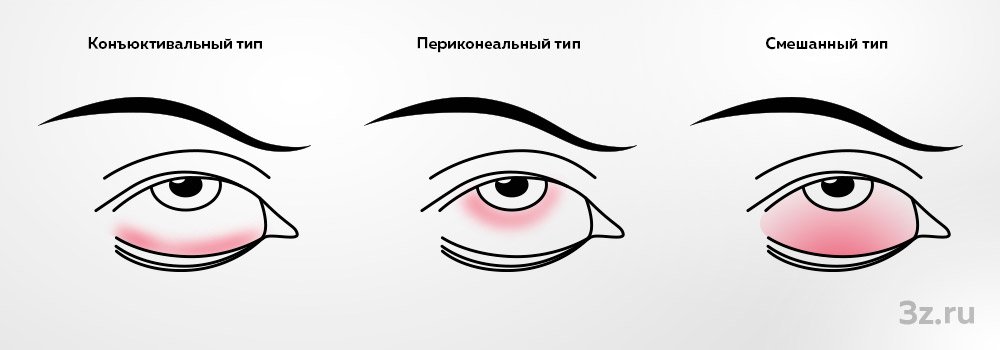 Типы синдрома «красного глаза»