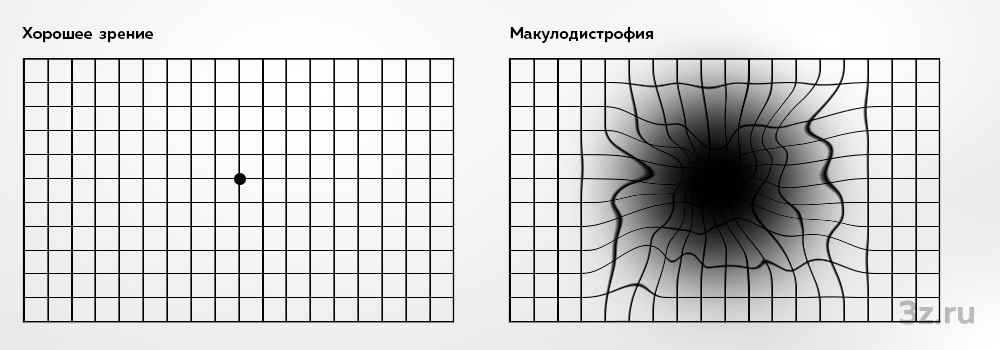 Тест сетчатки глаза. Тест Амслера при макулодистрофии. Макулодистрофия сетчатки. Макулодистрофии сетчатки глаза что это такое. Как видит глаз при макулодистрофии.